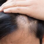 Dealing with Hormonal Hair Growth